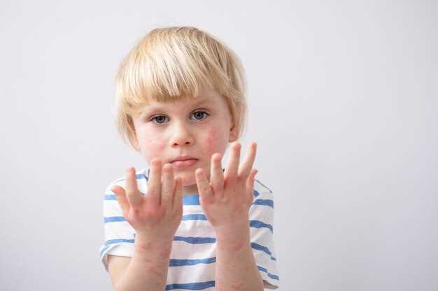 Инфекционные заболевания и характер кожных высыпаний